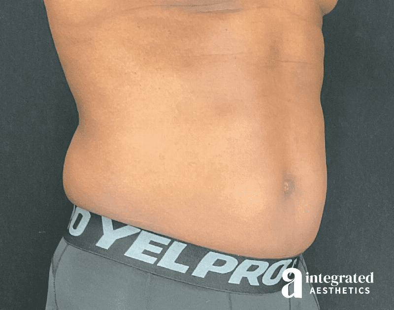 EmSculpt Before & After Gallery - Patient 133212683 - Image 6