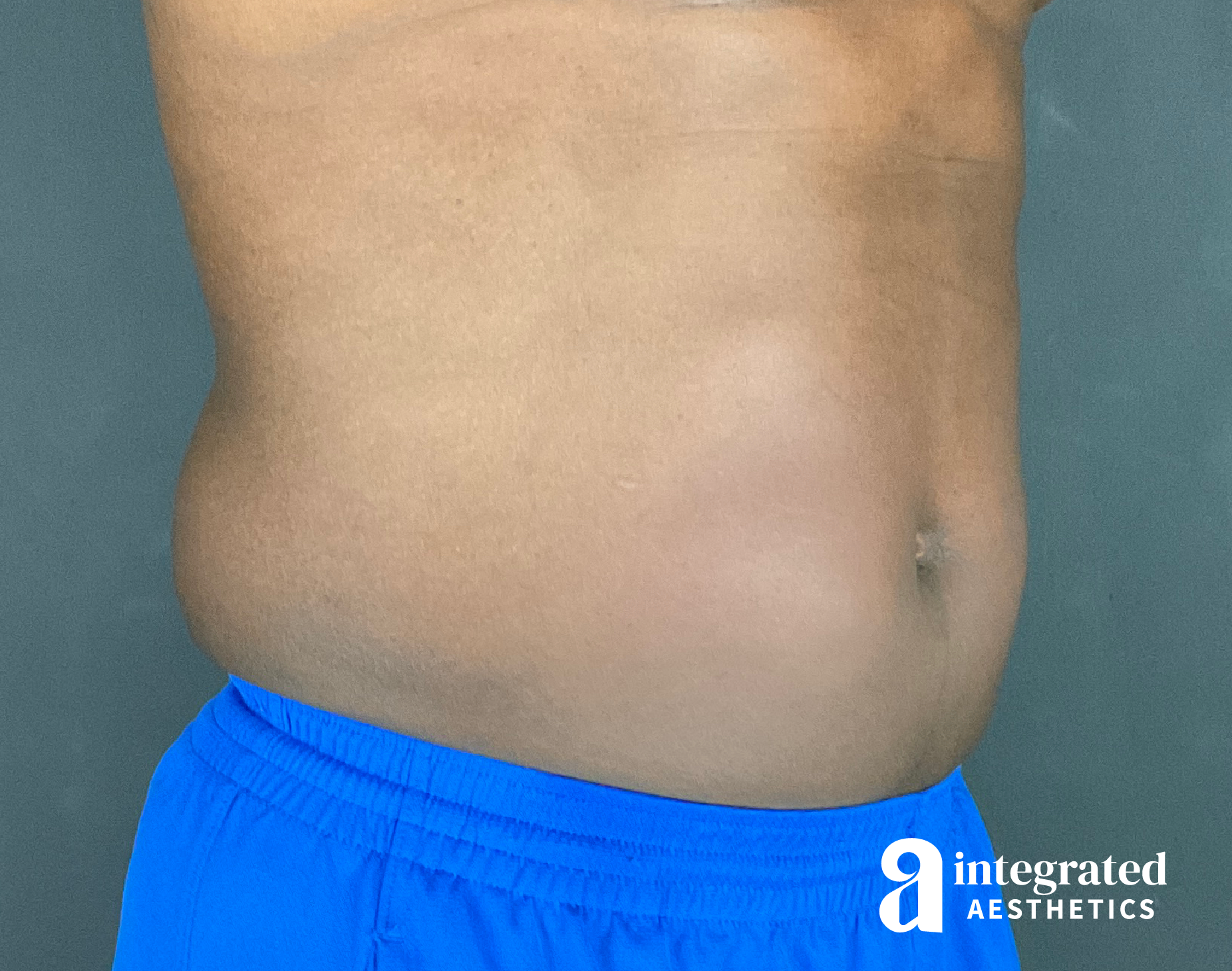 EmSculpt Before & After Gallery - Patient 133212683 - Image 5