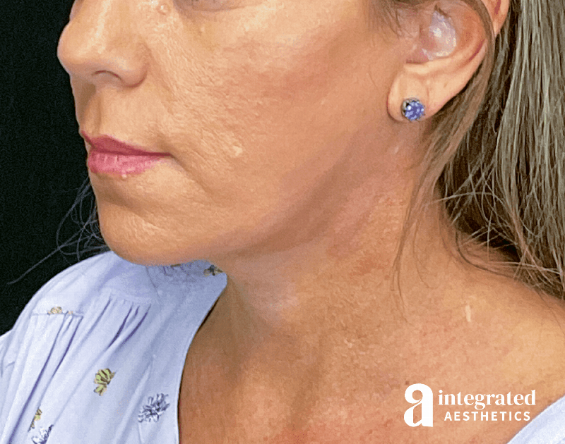 Facelift & Neck Lift Before & After Gallery - Patient 133212814 - Image 8