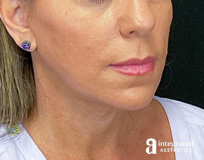 Facelift & Neck Lift Before & After Gallery - Patient 133212814 - Image 2