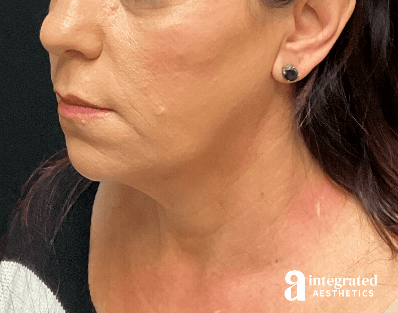 Facelift & Neck Lift Before & After Gallery - Patient 133212814 - Image 7