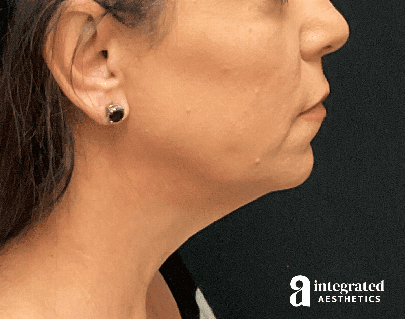 Facelift & Neck Lift Before & After Gallery - Patient 133212814 - Image 9