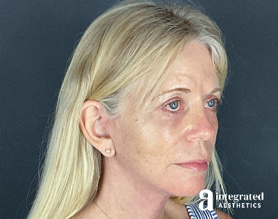 Facelift & Neck Lift Before & After Gallery - Patient 133212829 - Image 2