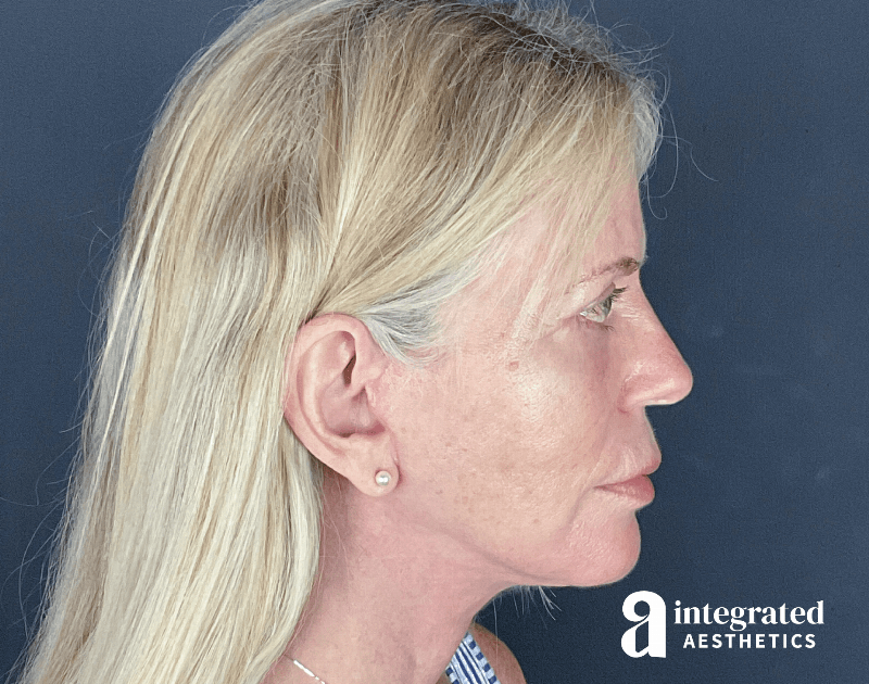 Facelift & Neck Lift Before & After Gallery - Patient 133212829 - Image 10