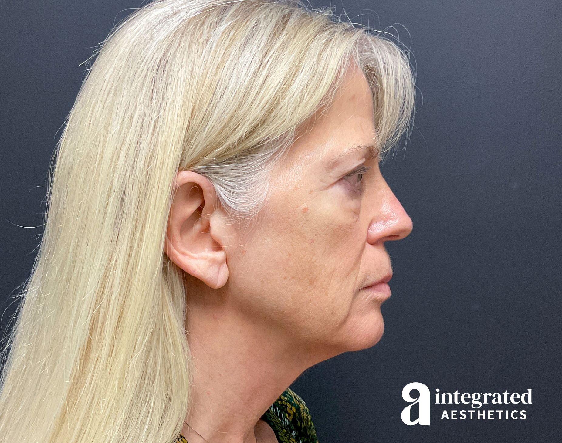 Facelift & Neck Lift Before & After Gallery - Patient 133212829 - Image 9