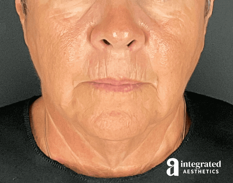 Facelift & Neck Lift Before & After Gallery - Patient 133212854 - Image 3