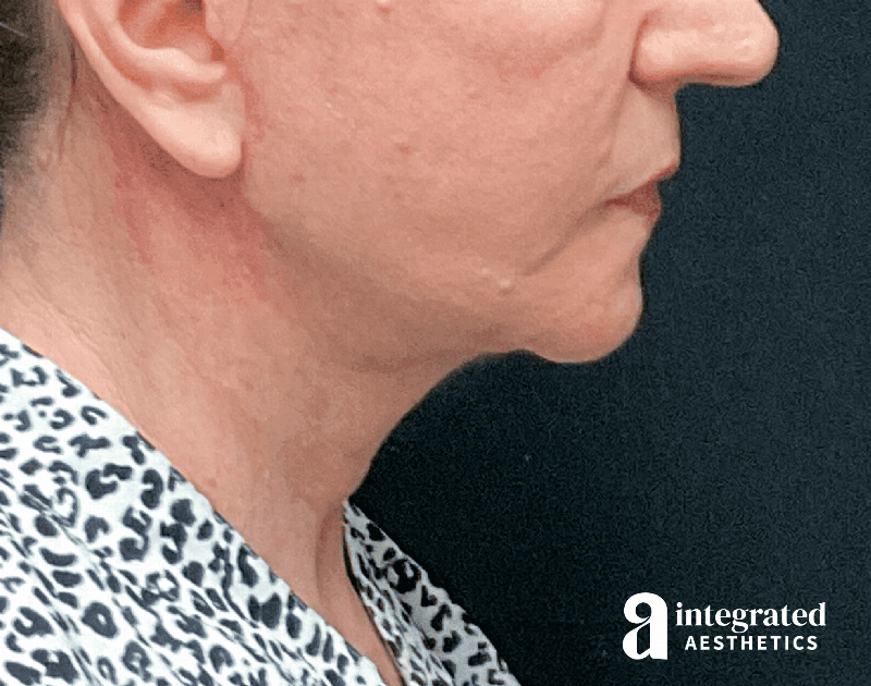 Facelift & Neck Lift Before & After Gallery - Patient 133212866 - Image 10