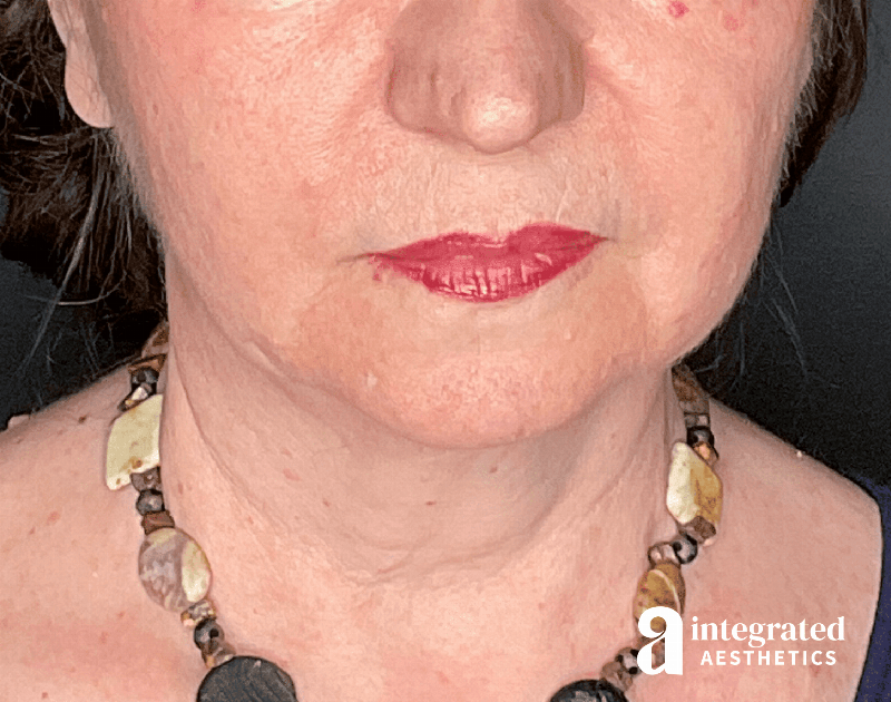 Facelift & Neck Lift Before & After Gallery - Patient 133212866 - Image 3