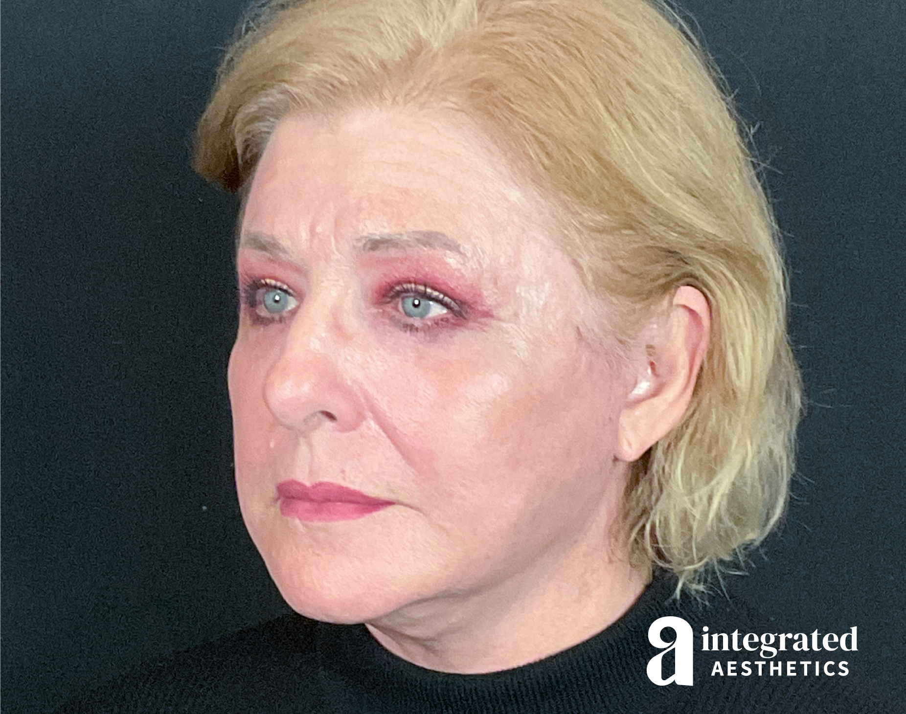 Facelift & Neck Lift Before & After Gallery - Patient 133212879 - Image 6