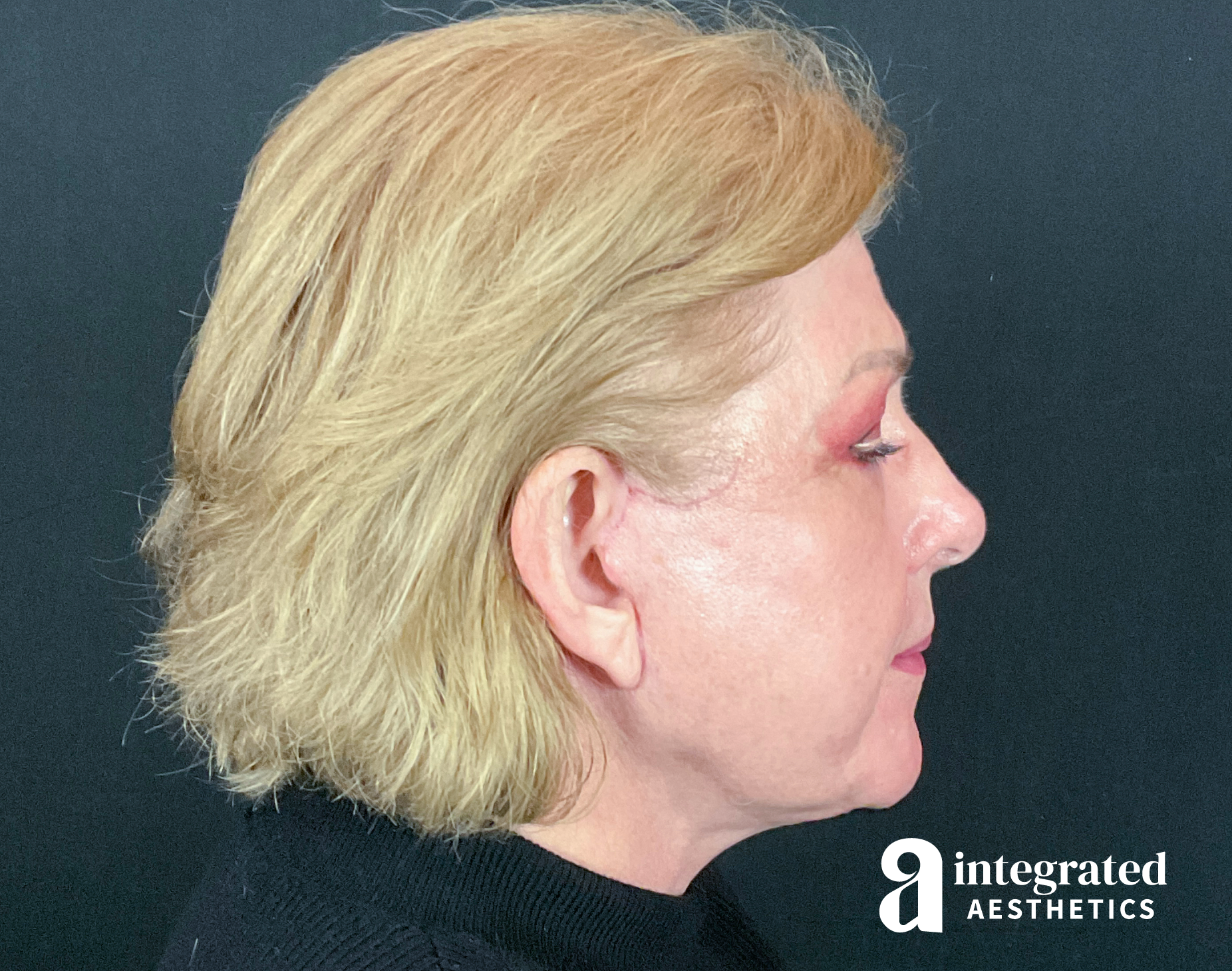 Facelift & Neck Lift Before & After Gallery - Patient 133212879 - Image 10