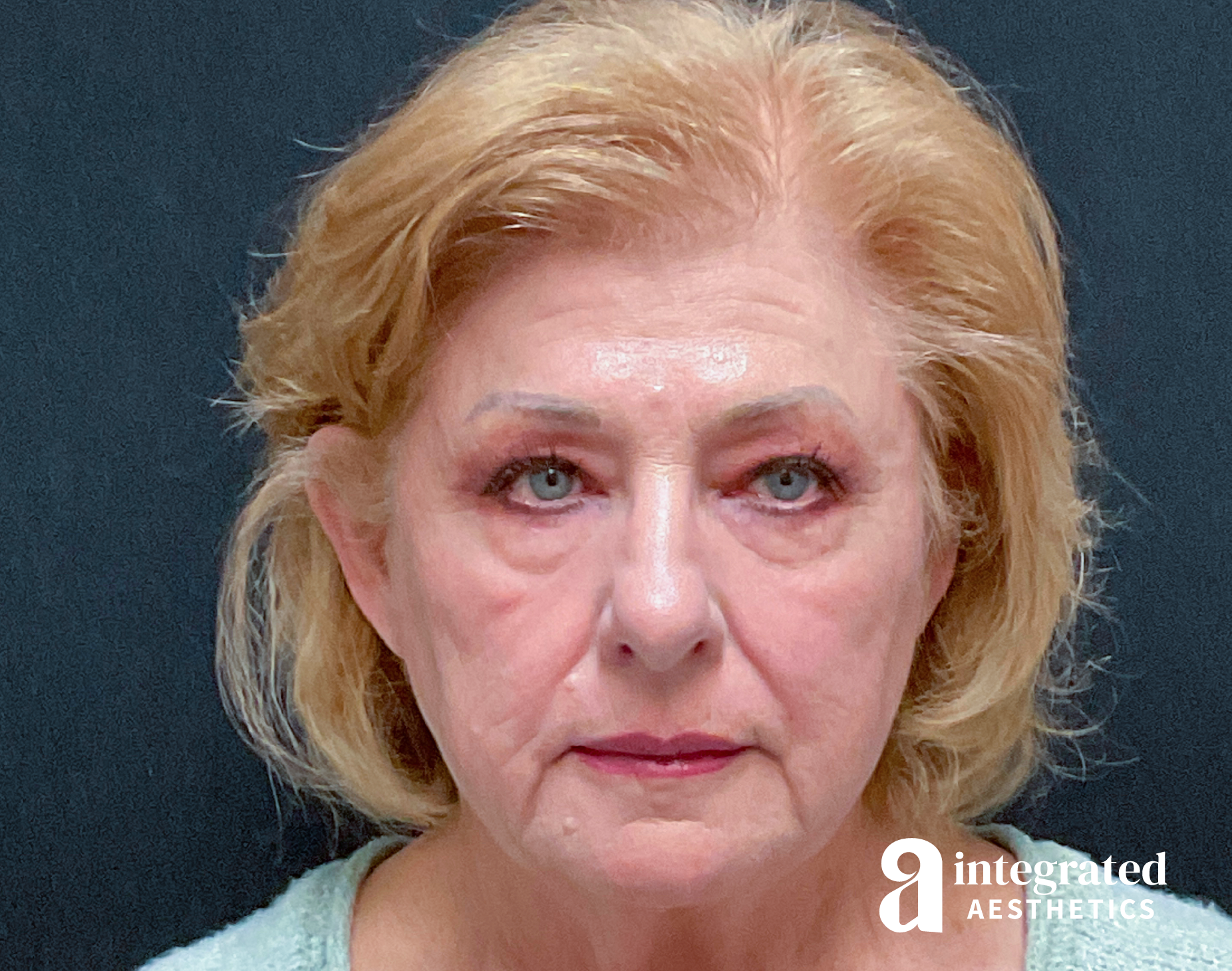 Facelift & Neck Lift Before & After Gallery - Patient 133212879 - Image 3