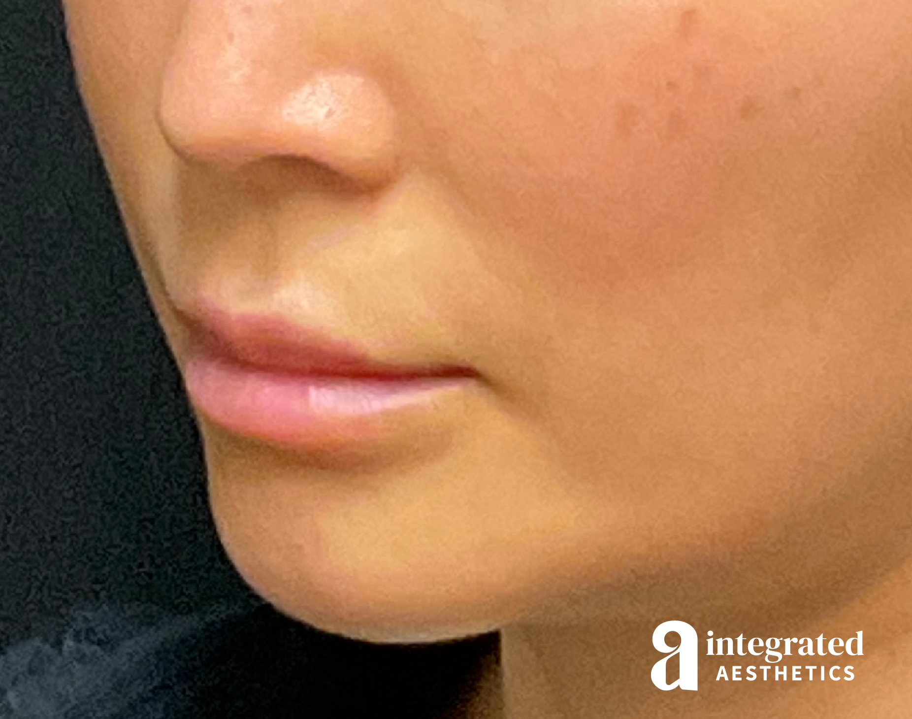 Lip Lift Before & After Gallery - Patient 133212957 - Image 3