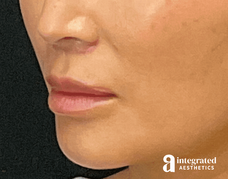 Lip Lift Before & After Gallery - Patient 133212957 - Image 4