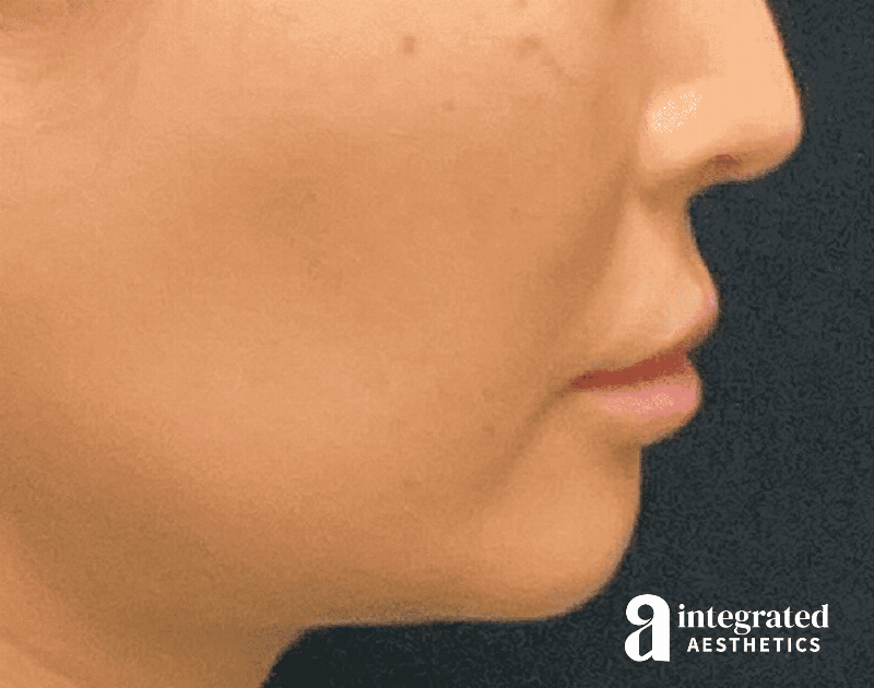 Lip Lift Before & After Gallery - Patient 133212957 - Image 9