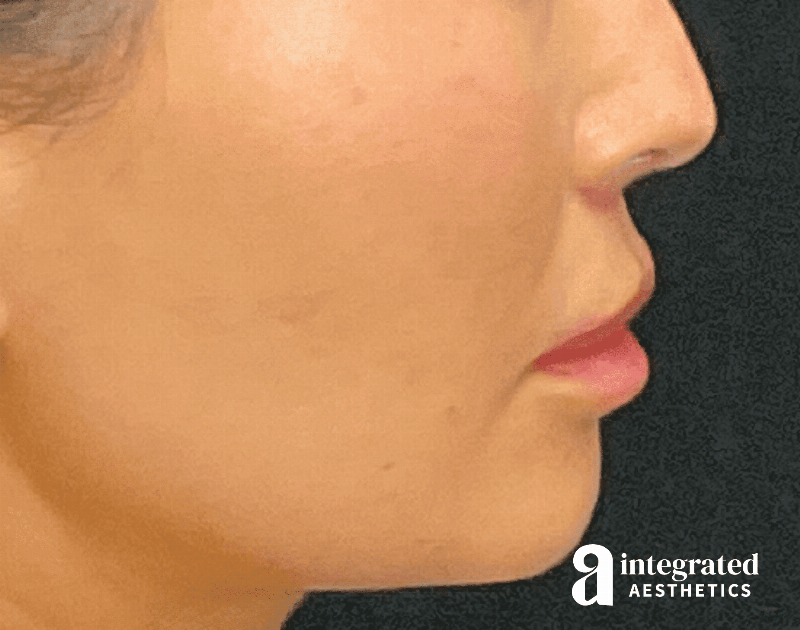 Lip Lift Before & After Gallery - Patient 133212957 - Image 10