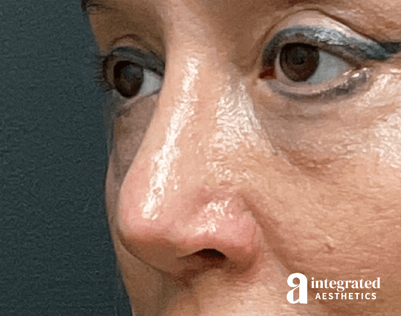 Rhinoplasty Before & After Gallery - Patient 133213227 - Image 4