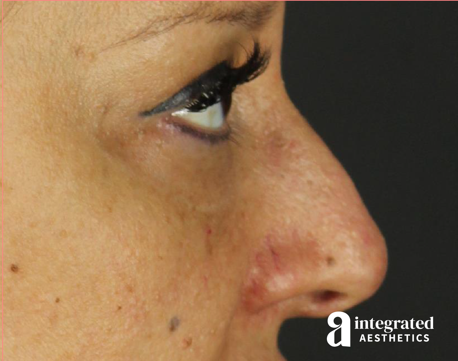 Rhinoplasty Before & After Gallery - Patient 133213227 - Image 7