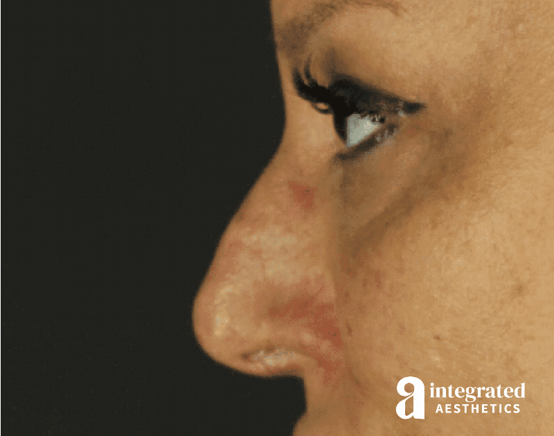 Rhinoplasty Before & After Gallery - Patient 133213227 - Image 9