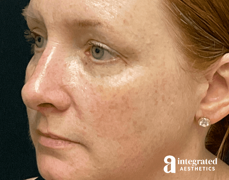 Rhinoplasty Before & After Gallery - Patient 133213248 - Image 4