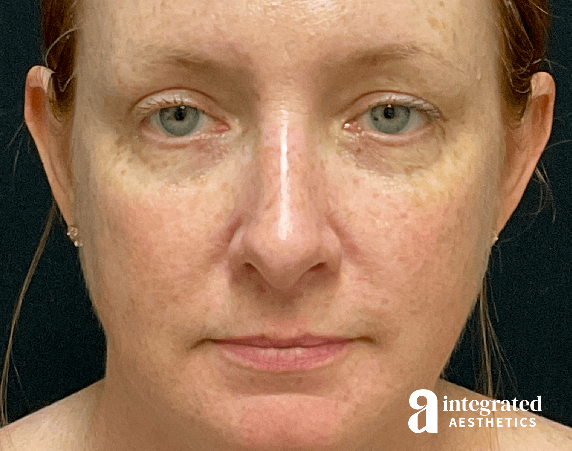 Rhinoplasty Before & After Gallery - Patient 133213248 - Image 8