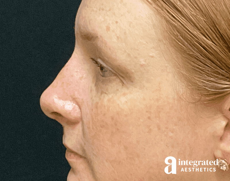 Rhinoplasty Before & After Gallery - Patient 133213248 - Image 10