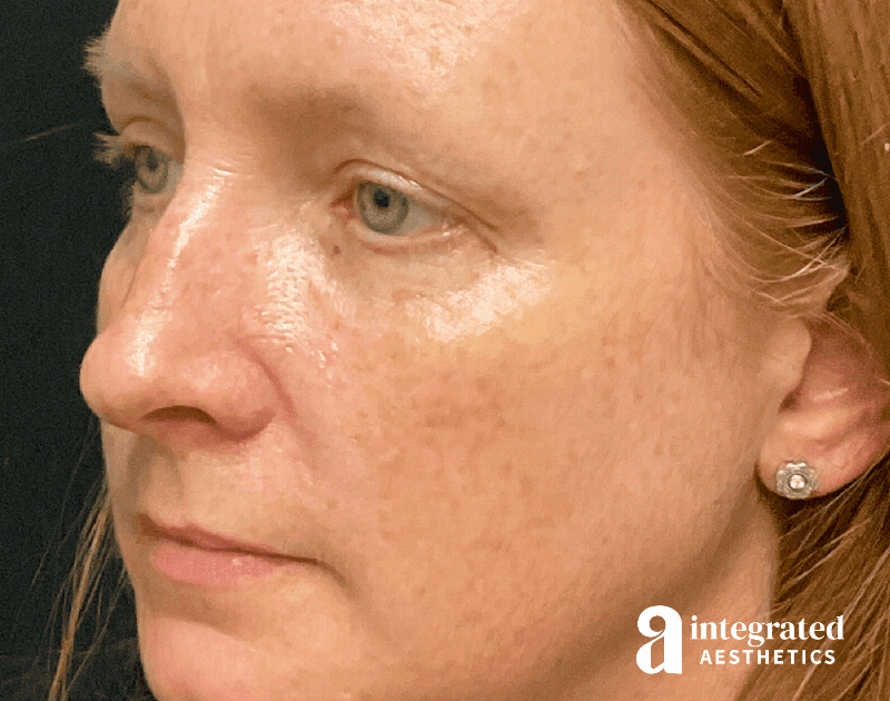 Rhinoplasty Before & After Gallery - Patient 133213248 - Image 3