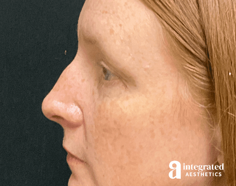 Rhinoplasty Before & After Gallery - Patient 133213248 - Image 9