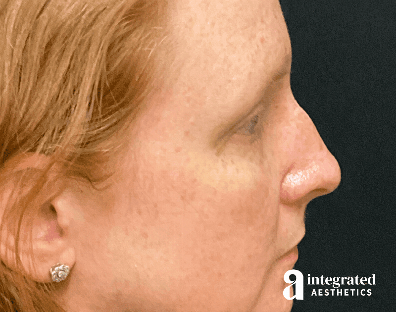 Rhinoplasty Before & After Gallery - Patient 133213248 - Image 1