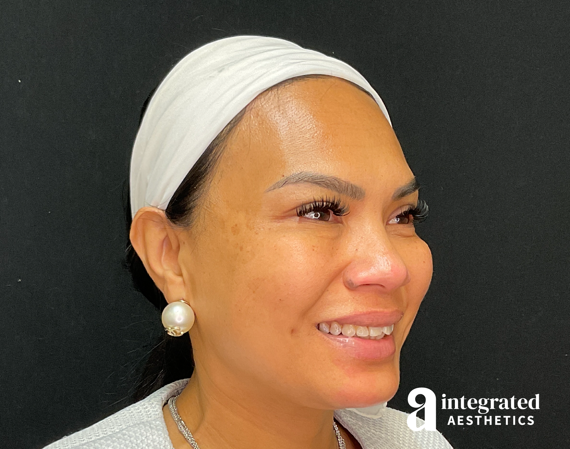 Wrinkle Relaxers Before & After Gallery - Patient 133213317 - Image 8