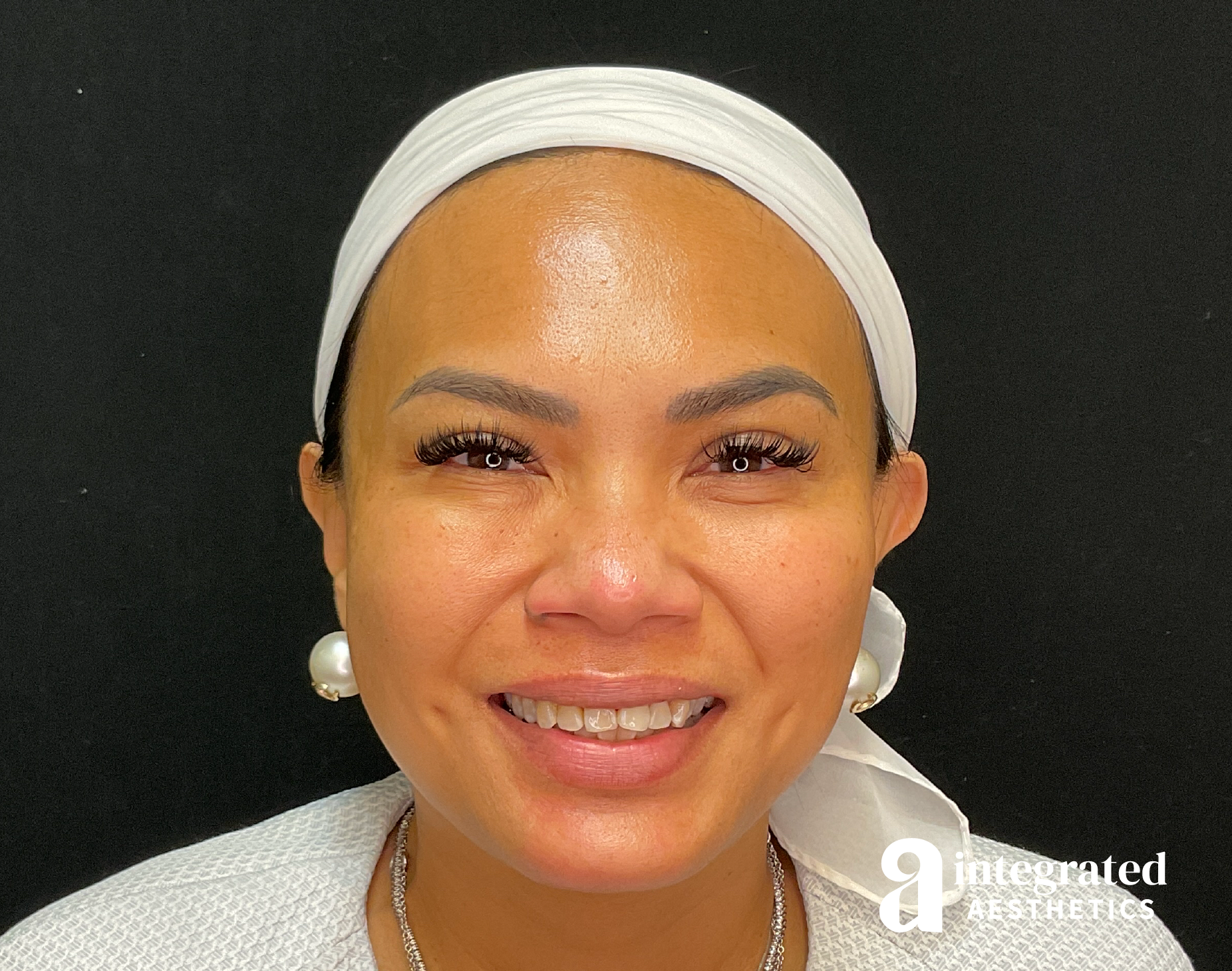 Wrinkle Relaxers Before & After Gallery - Patient 133213317 - Image 4