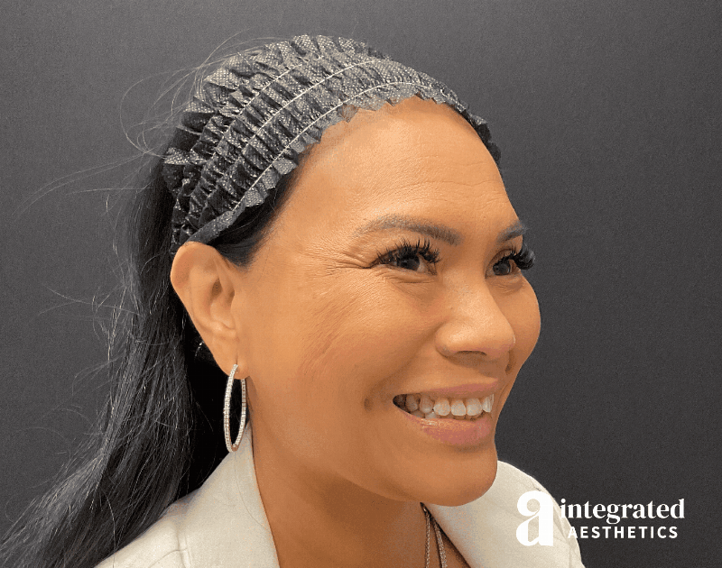 Wrinkle Relaxers Before & After Gallery - Patient 133213317 - Image 7