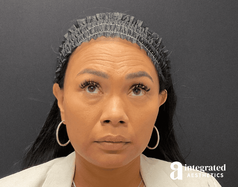 Wrinkle Relaxers Before & After Gallery - Patient 133213317 - Image 1