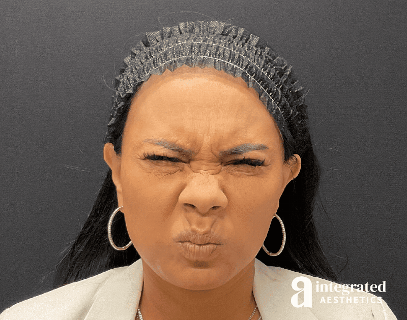 Wrinkle Relaxers Before & After Gallery - Patient 133213317 - Image 5