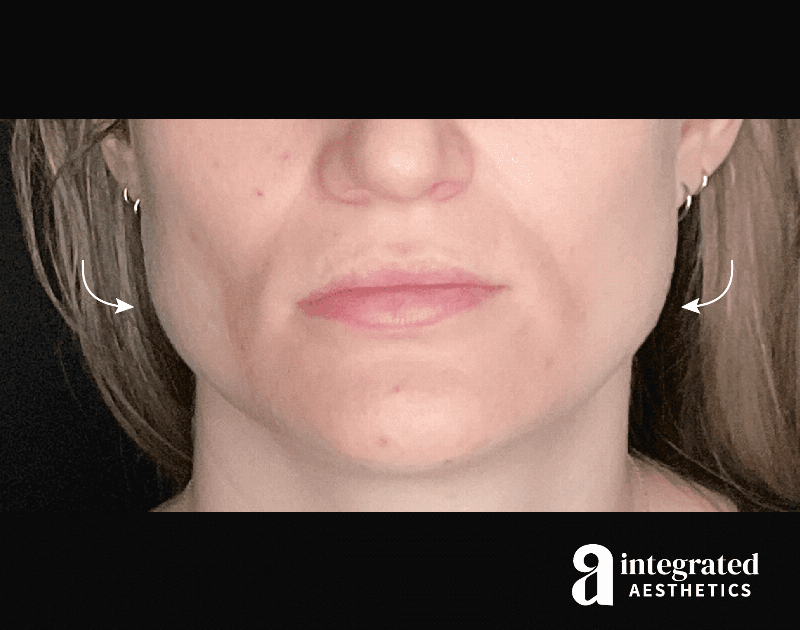 Wrinkle Relaxers Before & After Gallery - Patient 133213338 - Image 1