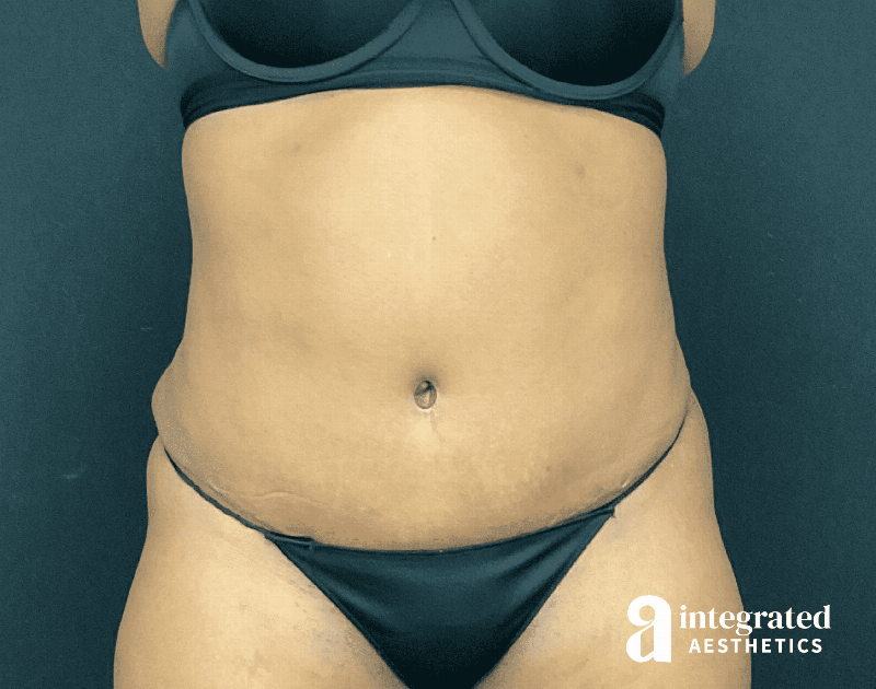 Tummy Tuck Before & After Gallery - Patient 133213462 - Image 2