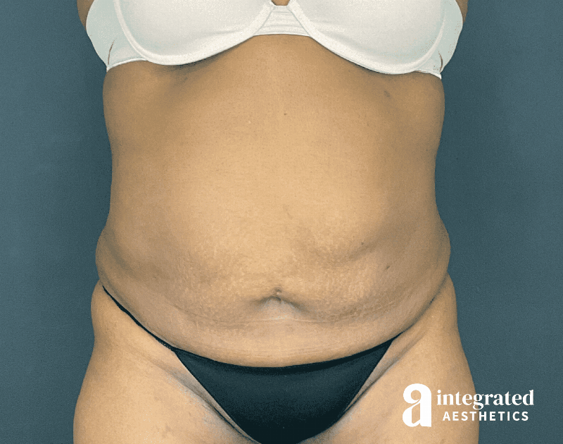 Tummy Tuck Before & After Gallery - Patient 133213462 - Image 1