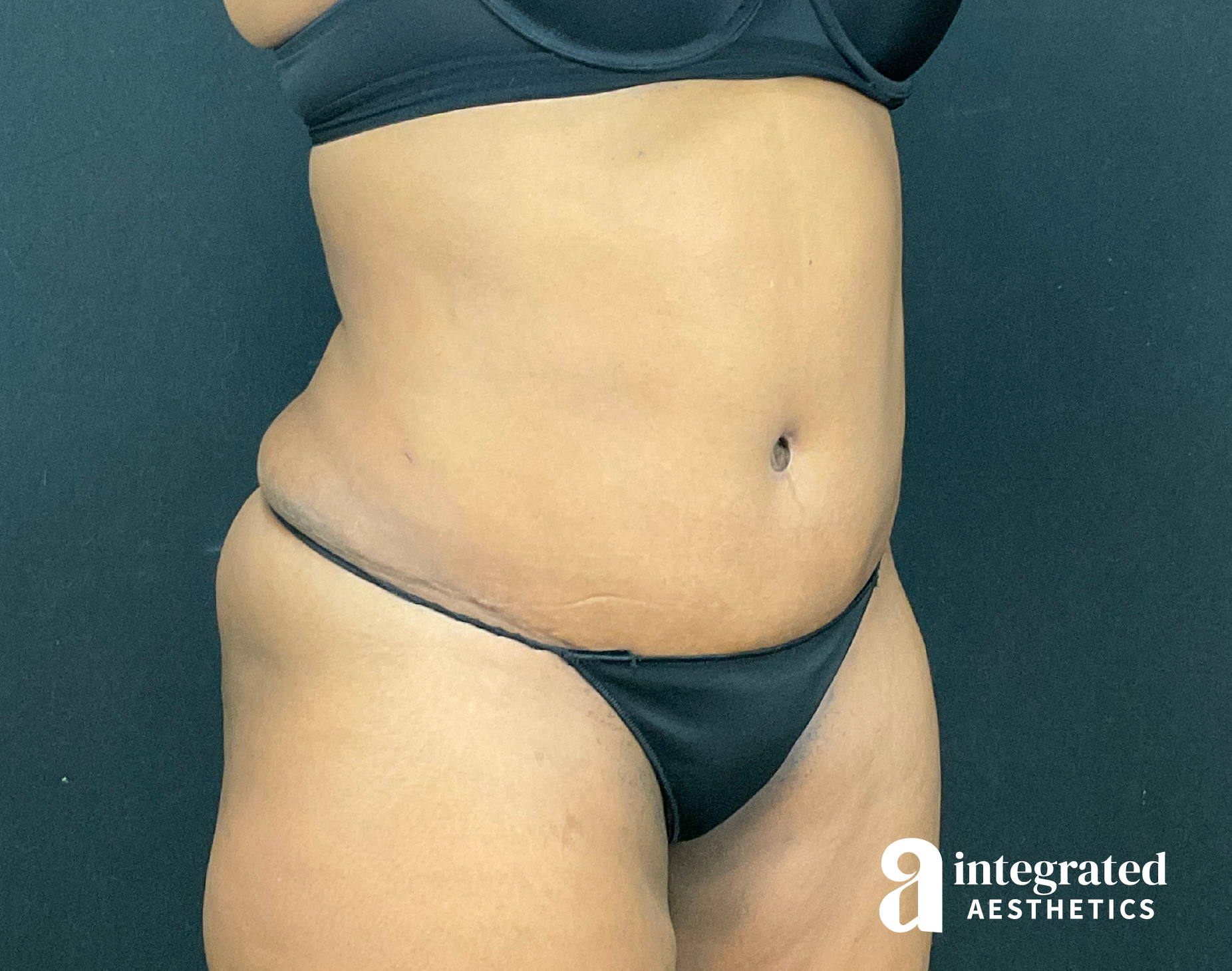 Tummy Tuck Before & After Gallery - Patient 133213462 - Image 4