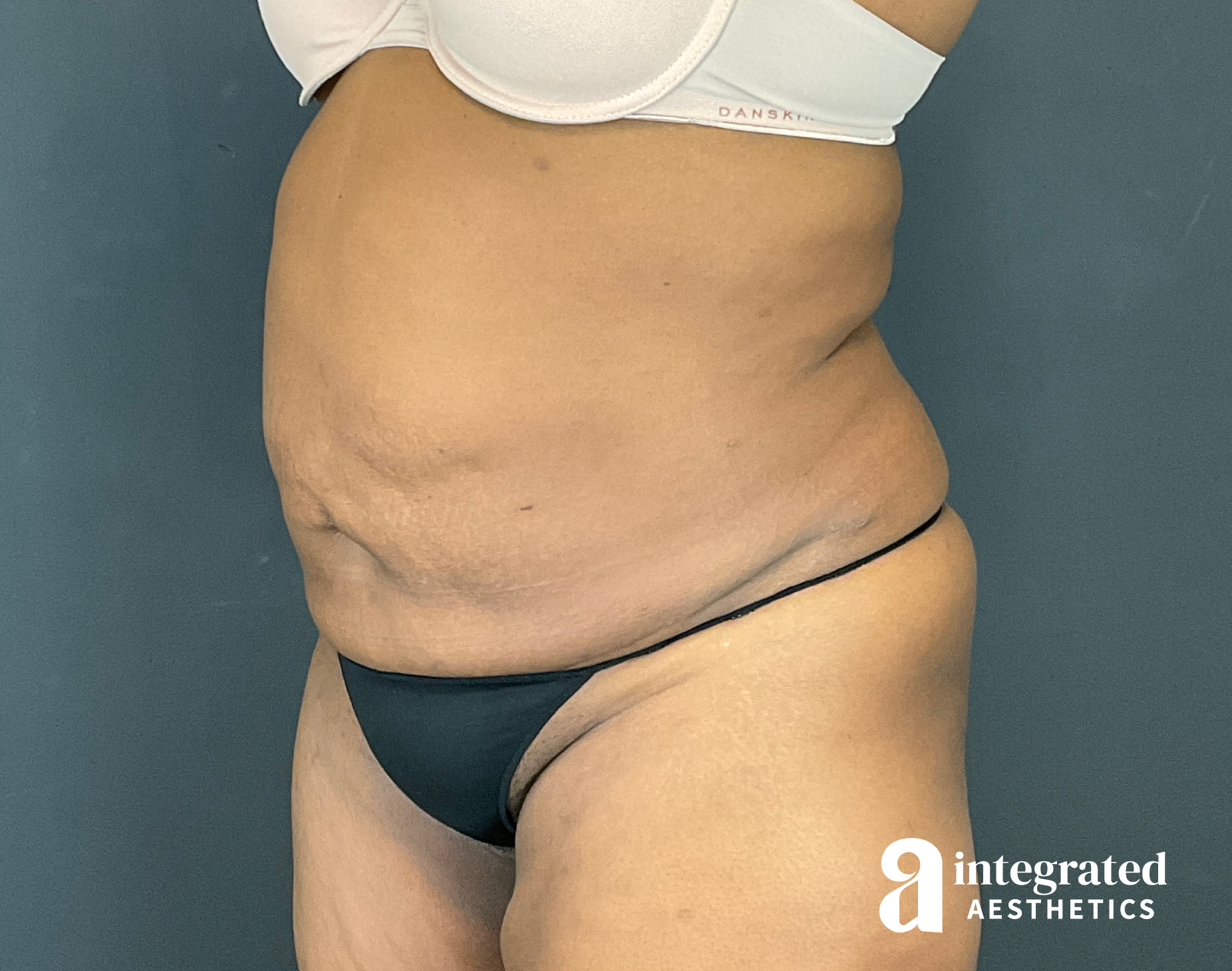 Tummy Tuck Before & After Gallery - Patient 133213462 - Image 5