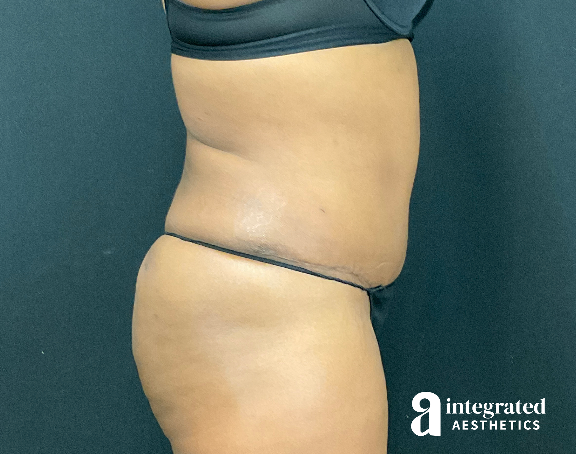 Tummy Tuck Before & After Gallery - Patient 133213462 - Image 8