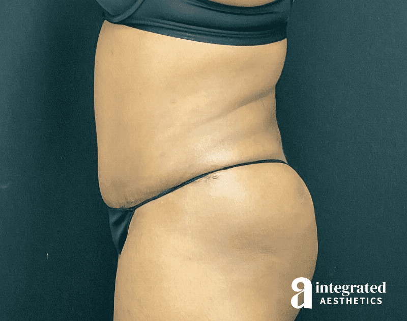 Tummy Tuck Before & After Gallery - Patient 133213462 - Image 10