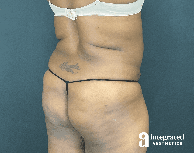 Tummy Tuck Before & After Gallery - Patient 133213462 - Image 13