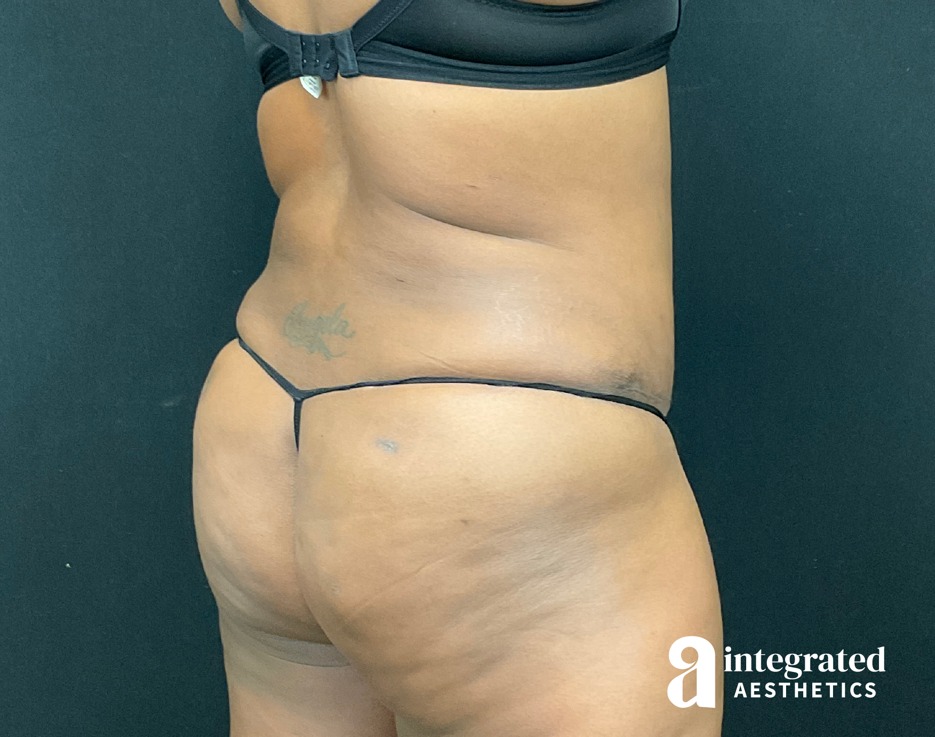 Tummy Tuck Before & After Gallery - Patient 133213462 - Image 14