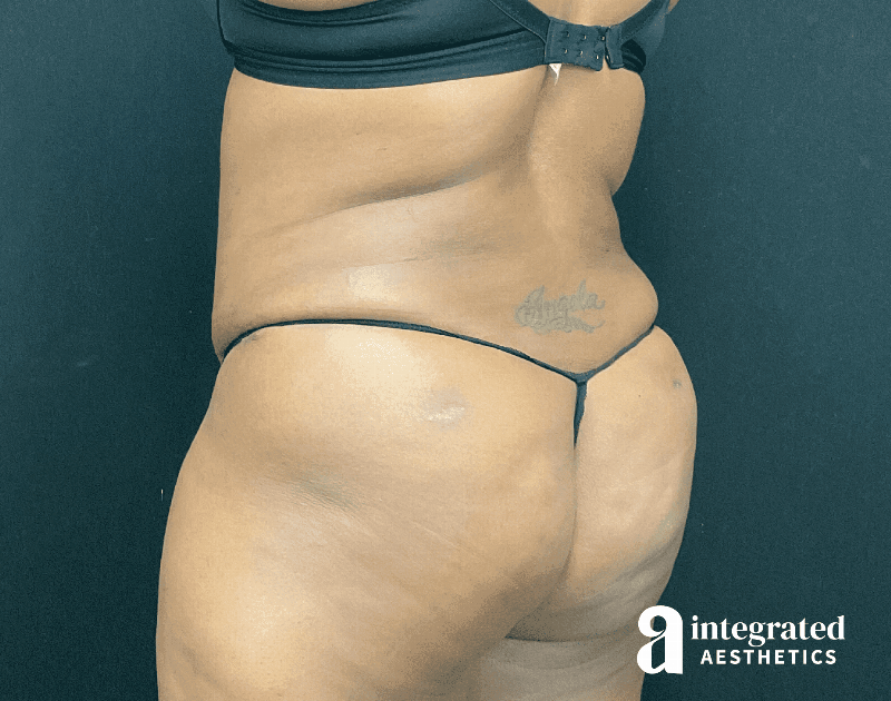 Tummy Tuck Before & After Gallery - Patient 133213462 - Image 16