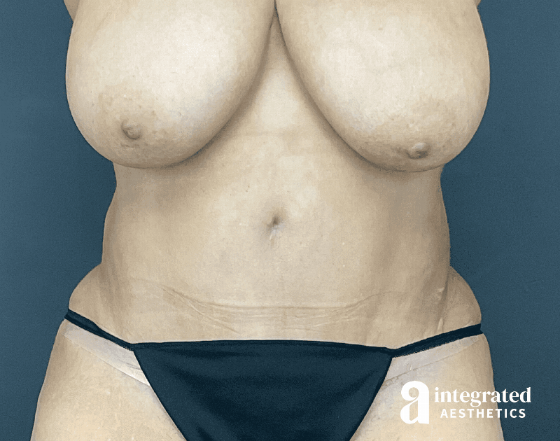 Tummy Tuck Before & After Gallery - Patient 133213465 - Image 2