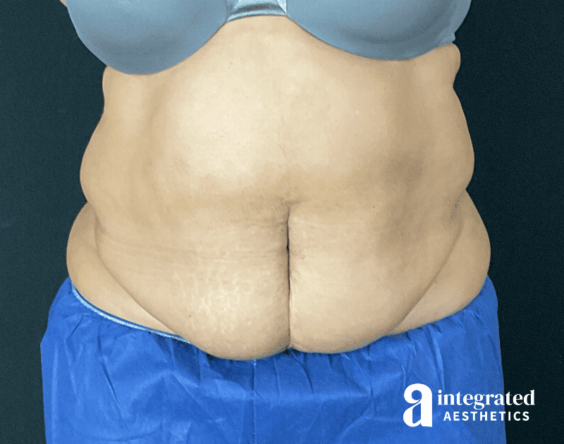 Tummy Tuck Before & After Gallery - Patient 133213465 - Image 1