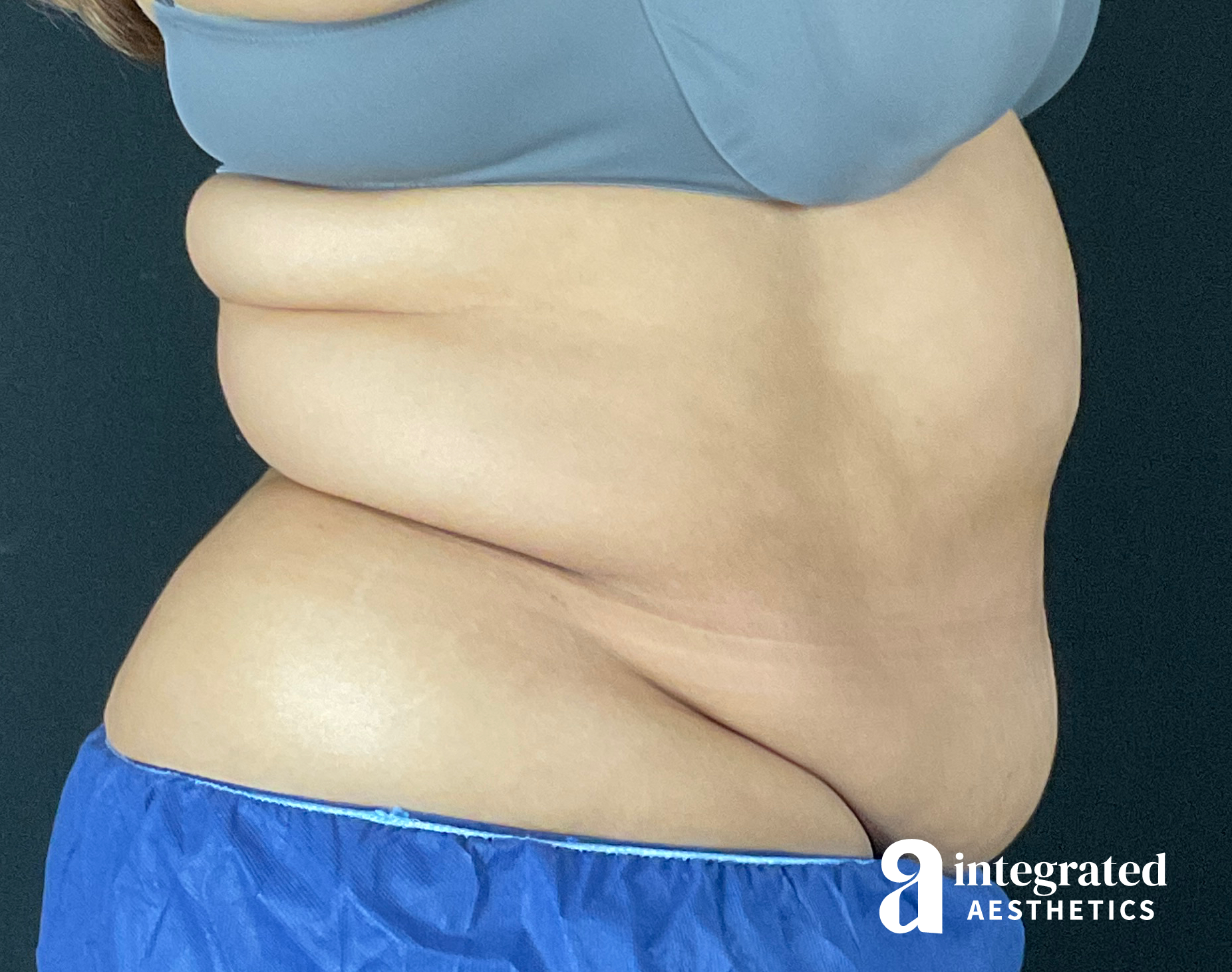 Tummy Tuck Before & After Gallery - Patient 133213465 - Image 9