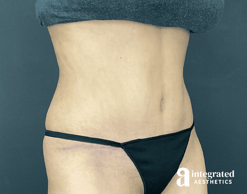 Tummy Tuck Before & After Gallery - Patient 133213479 - Image 6