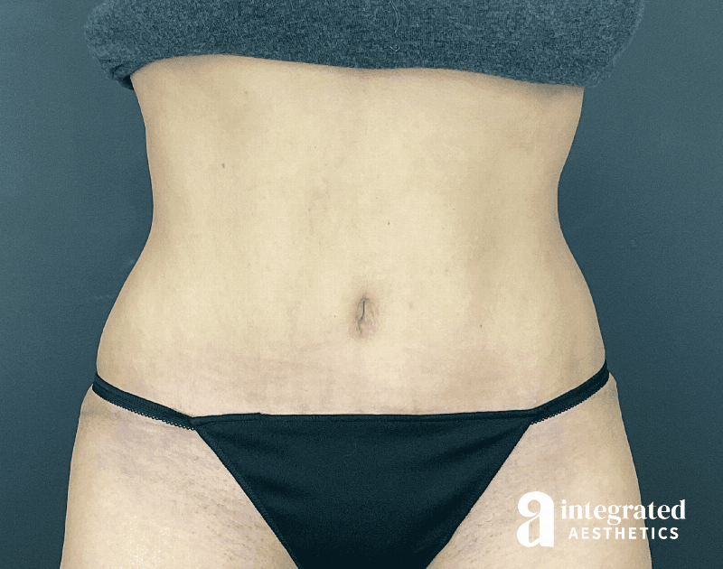 Tummy Tuck Before & After Gallery - Patient 133213479 - Image 2