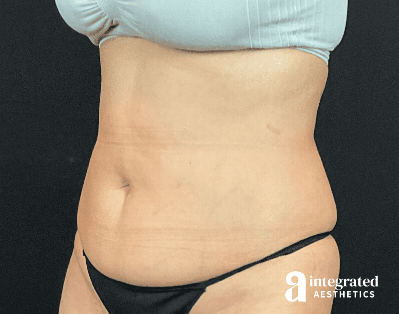 Tummy Tuck Before & After Gallery - Patient 133213479 - Image 3