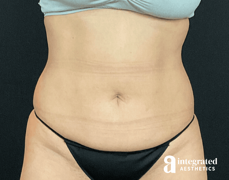 Tummy Tuck Before & After Gallery - Patient 133213479 - Image 1